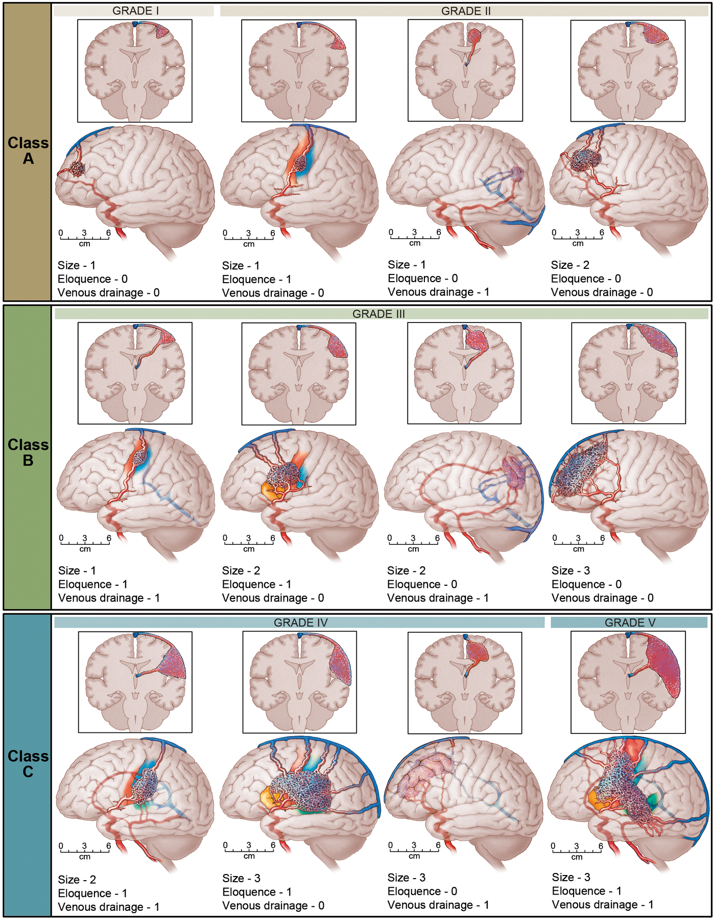 Arteriovenous Malformations