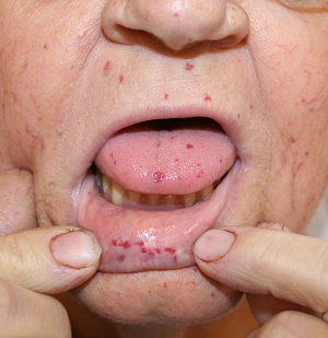 Hereditary Haemorrhagic Telangiectasia