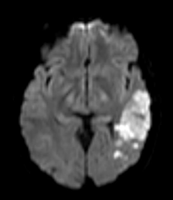 Left parietal Infarct